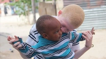 Afrikalı albinolar 'beyaz' birlikte doğacak ümidiyle yaşıyor