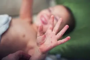 Uzmanından ‘el, ayak, ağız hastalığı’ uyarısı: Havuza giren çocuklarda daha sık görülüyor